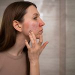 Woman checking her skin for rosacea – dermatology care for sensitive skin in Dubai