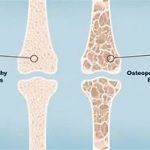 osteoporosis-treatment-dubai-strong-bones-prevention