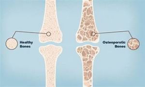 osteoporosis-treatment-dubai-strong-bones-prevention