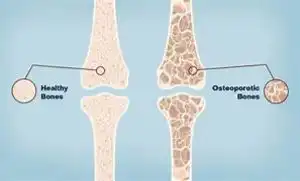 osteoporosis-treatment-dubai-strong-bones-prevention