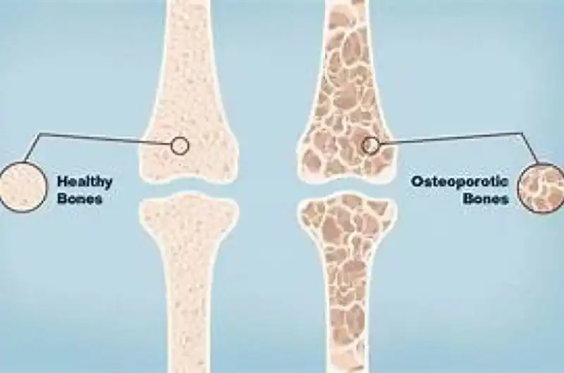 Osteoporosis: Keeping Bones Strong as You Age