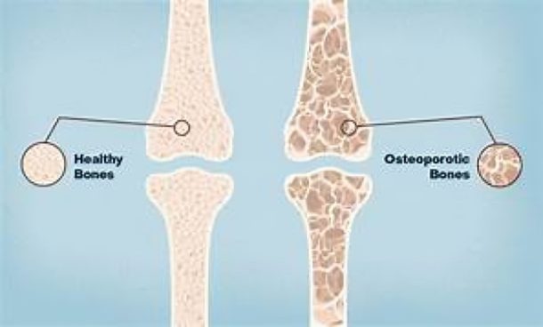 Osteoporosis: Keeping Bones Strong as You Age
