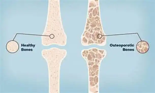 Osteoporosis: Keeping Bones Strong as You Age